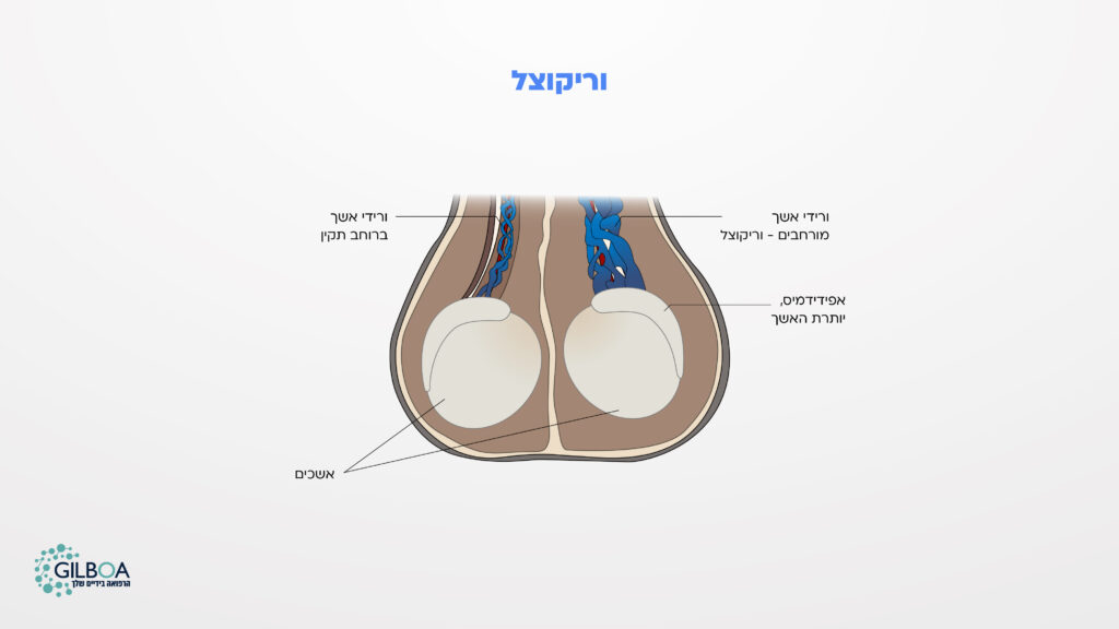 פוריות הגבר - וריקוצל