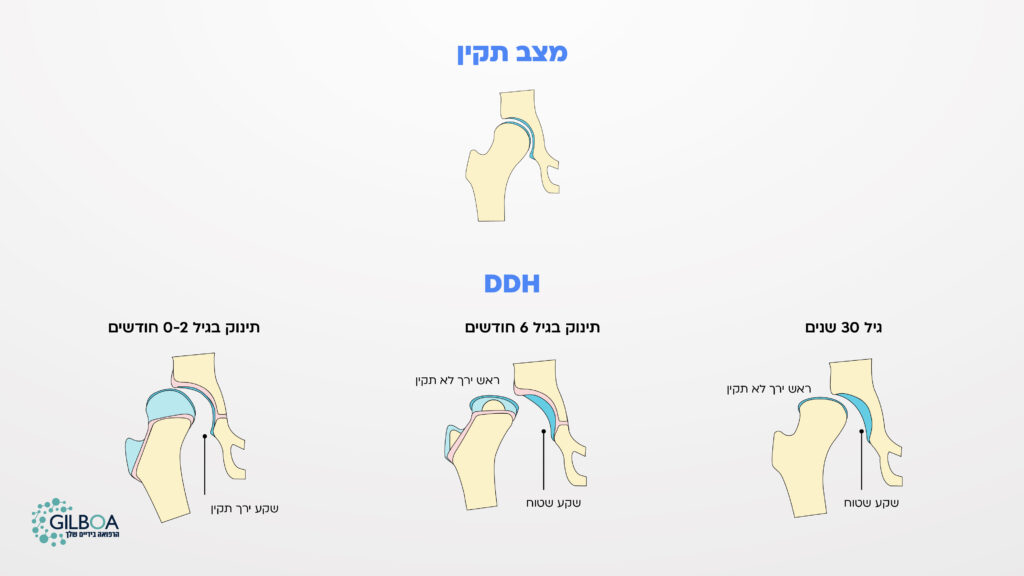פרקי ירכיים - מול DDH תקין