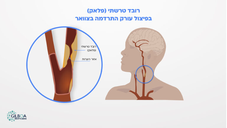 פלאק - רובד טרשתי
